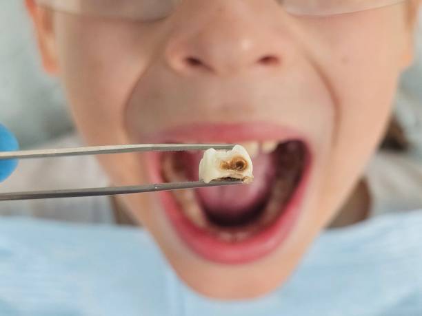 Best Dentist for Tooth Abscess  in Pigeon Forge, TN